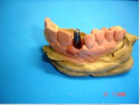 /album/galeria-de-fotos-carga-imediata-apos-exodontia-atraumatica-/carga-imediata-com-exodontia-atraumatica12-jpg/